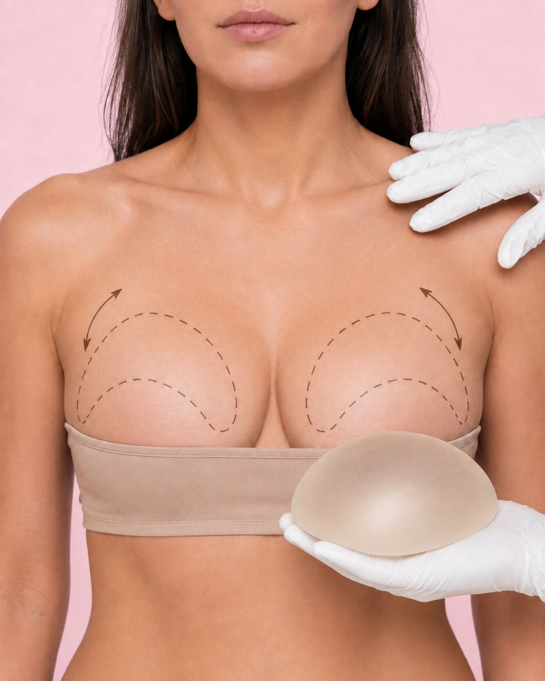 Implantátum csere